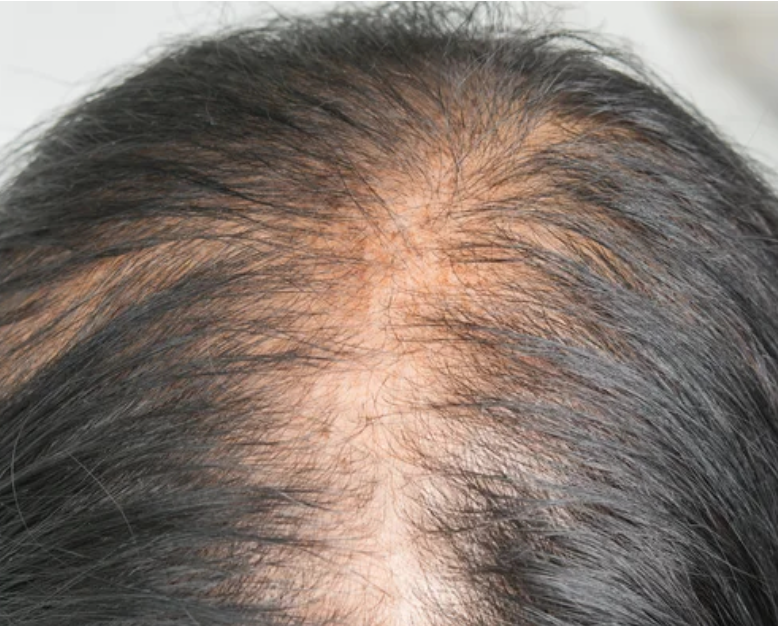 Hair Loss